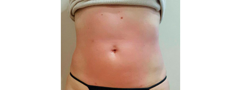 After-Mesoterapia